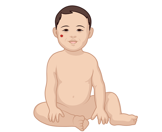 Hemangioma